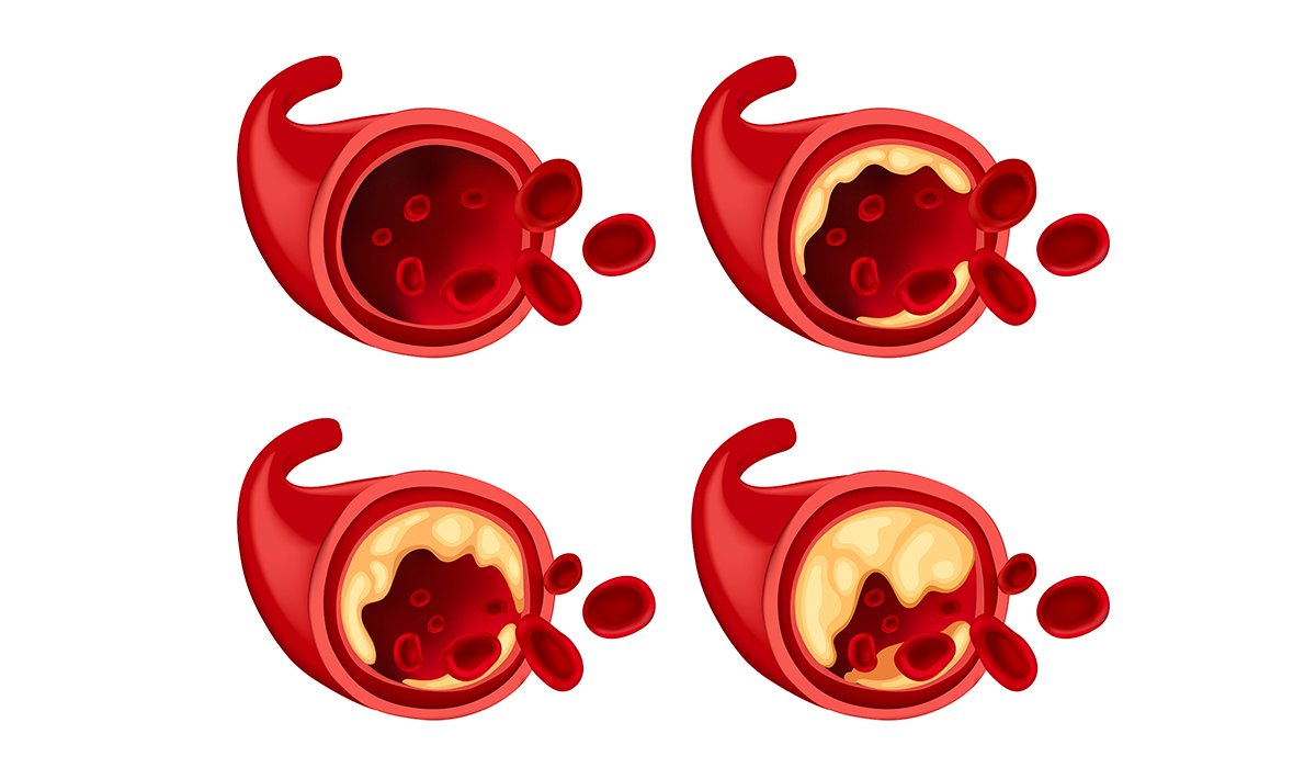 Arteriosclerosis